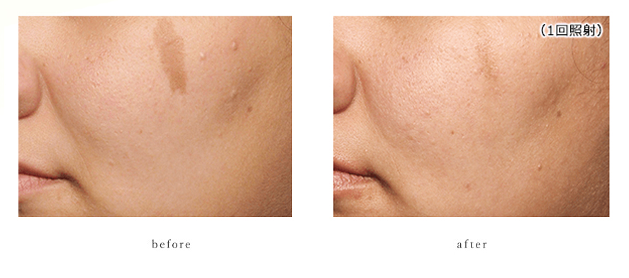 ピコレーザー症例１