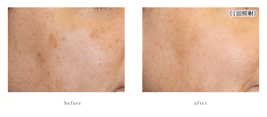 ピコレーザー症例２