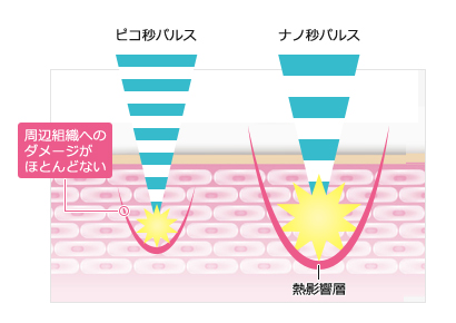 周辺組織へのダメージがほとんどないピコ秒パルス